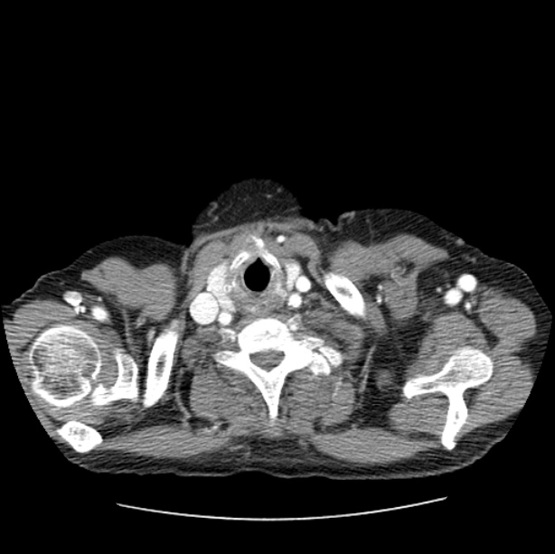 Autosomal dominant polycystic kidney disease (Radiopaedia 27851-28094 B 1).jpg