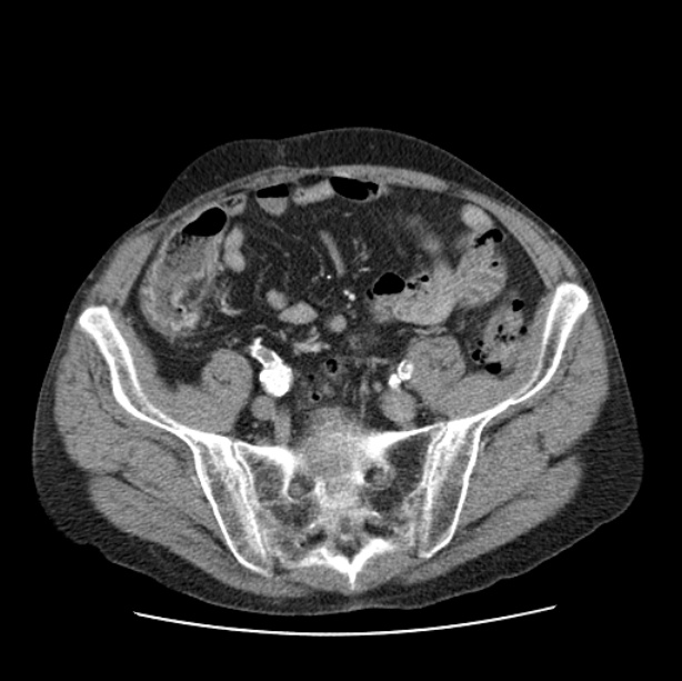 Autosomal dominant polycystic kidney disease (Radiopaedia 27851-28094 B 98).jpg