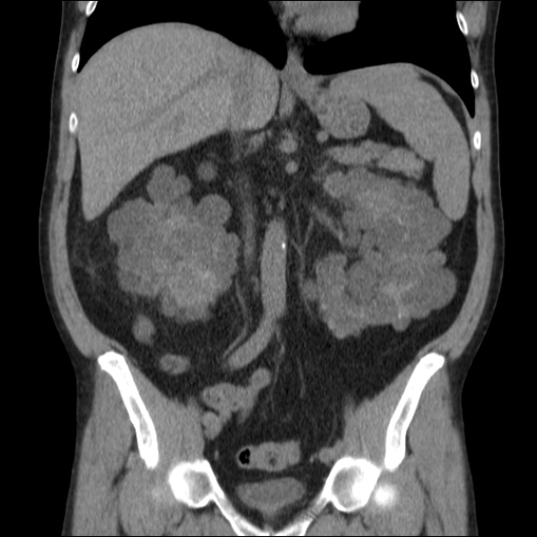 File:Autosomal dominant polycystic kidney disease (Radiopaedia 36539-38101 C 35).jpg