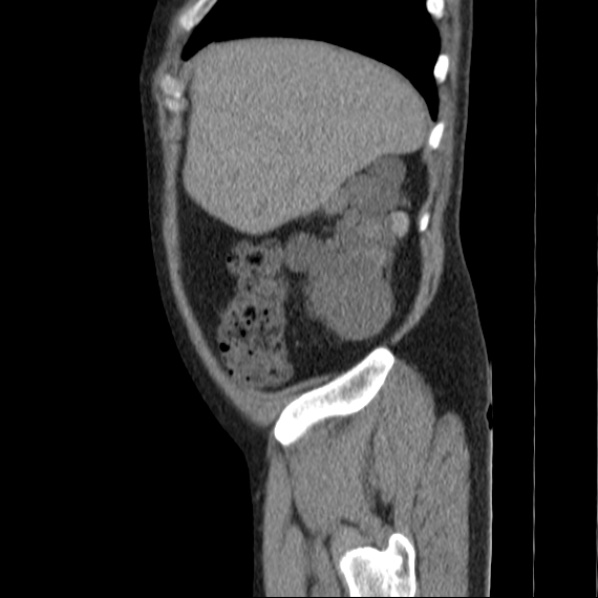 Autosomal dominant polycystic kidney disease (Radiopaedia 36539-38101 D 15).jpg