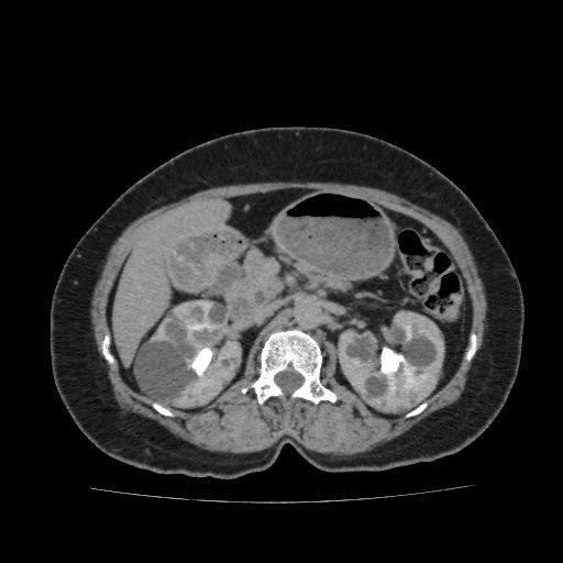 Autosomal dominant polycystic kidney disease (Radiopaedia 38189-40194 Axial C+ delayed 17).jpg