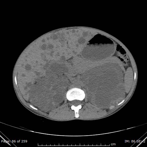 Autosomal dominant polycystic kidney disease (Radiopaedia 44122-47684 Axial non-contrast 31).jpg