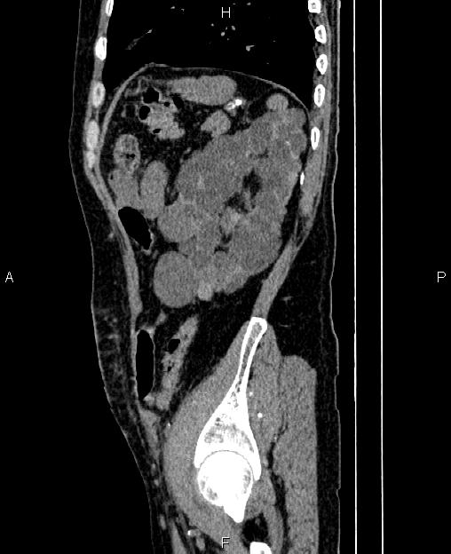 Autosomal dominant polycystic kidney disease (Radiopaedia 87830-104287 C 73).jpg