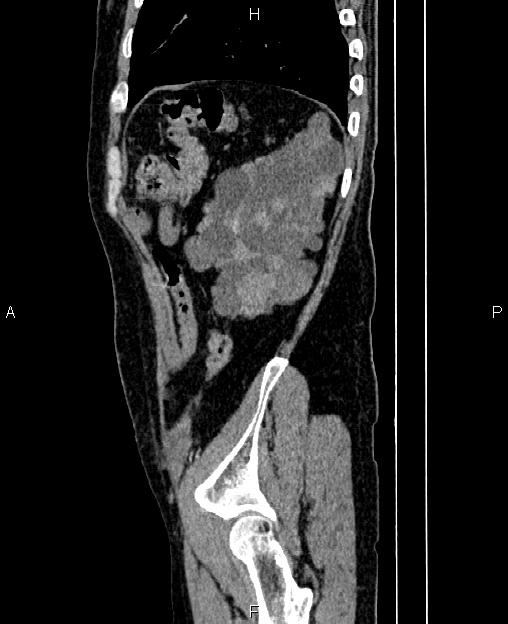 Autosomal dominant polycystic kidney disease (Radiopaedia 87830-104287 C 78).jpg