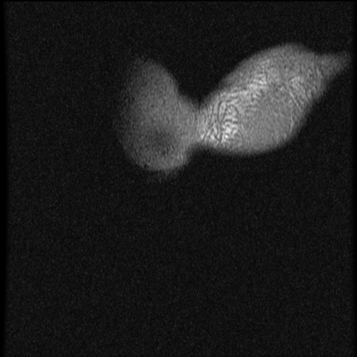 File:Avascular necrosis - scaphoid non-union (Radiopaedia 63457-72065 Coronal T1 1).jpg