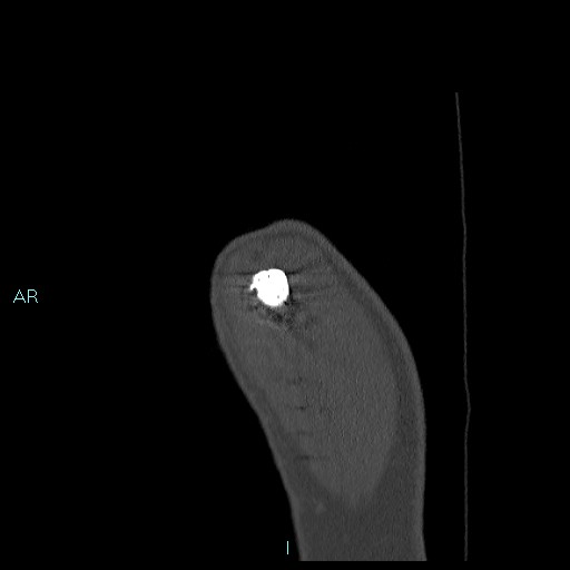 Avascular necrosis after fracture dislocations of the proximal humerus (Radiopaedia 88078-104655 Sagittal bone window 5).jpg