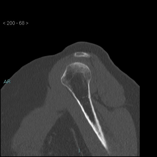 Avascular necrosis of the shoulder - Cruess stage I (Radiopaedia 77674-89887 Sagittal bone window 67).jpg