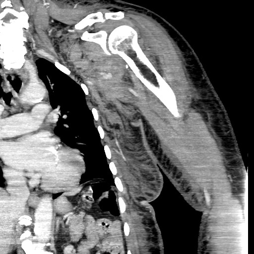 File:Axillary arterial pseudoaneurysm (Radiopaedia 24925-25195 B 5).jpg