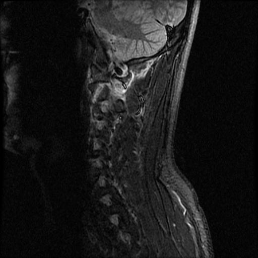 File:Axis fracture - MRI (Radiopaedia 71925-82375 Sagittal STIR 8).jpg