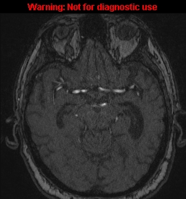 Azygos anterior cerebral artery (Radiopaedia 59325-66677 Axial MRA 67).jpg