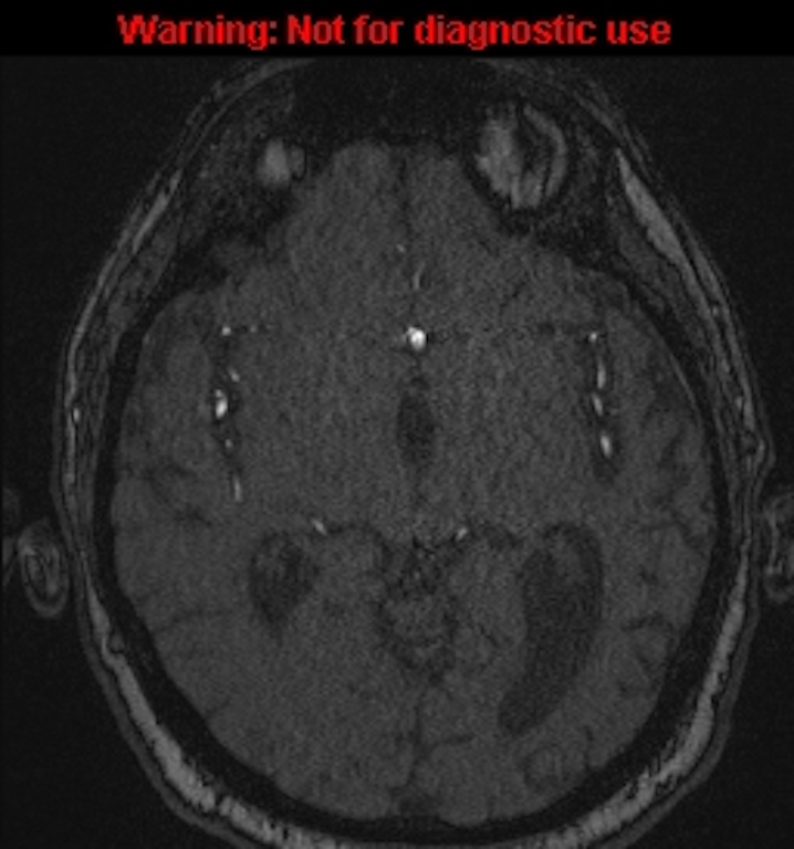 Azygos anterior cerebral artery (Radiopaedia 59325-66677 Axial MRA 78).jpg