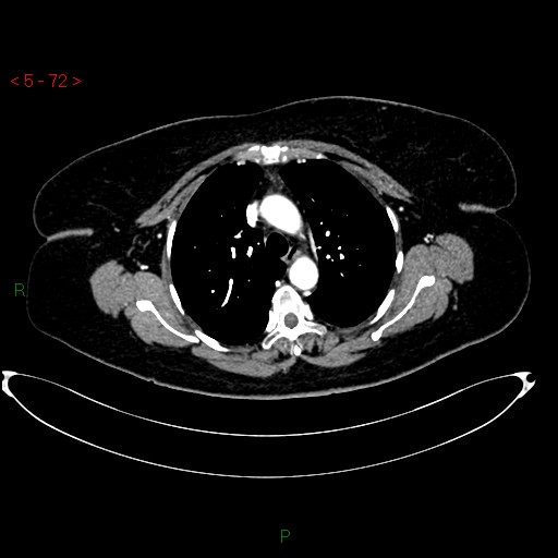 Azygos fissure and lobe (Radiopaedia 47620-52278 A 58).jpg