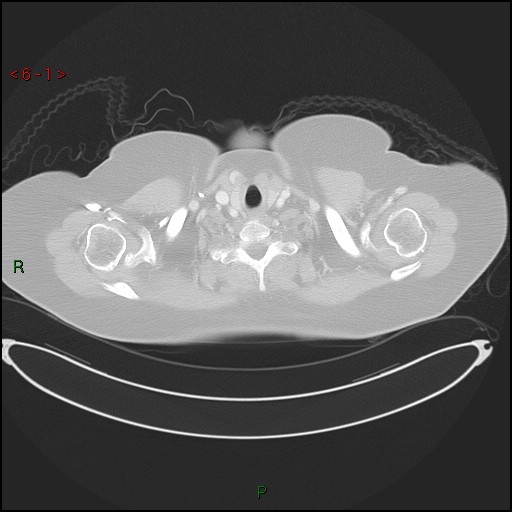 Azygos fissure and lobe (Radiopaedia 47620-52278 Axial lung window 1).jpg