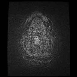 Balo concentric sclerosis (Radiopaedia 53875-59982 Axial LAVA C+ 272).jpg