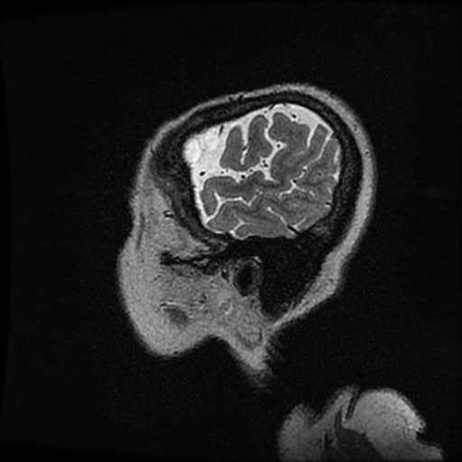 Balo concentric sclerosis (Radiopaedia 53875-59982 Sagittal 3D FSE 264).jpg