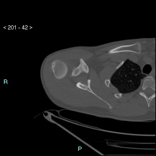 Bankart lesion with glenoid bone defect - assessment TC with PICO method (Radiopaedia 42855-93901 Axial bone window 41).jpg