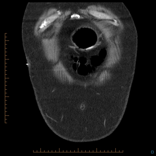 Bariatric balloon causing gastric outlet obstruction (Radiopaedia 54449-60672 B 2).jpg