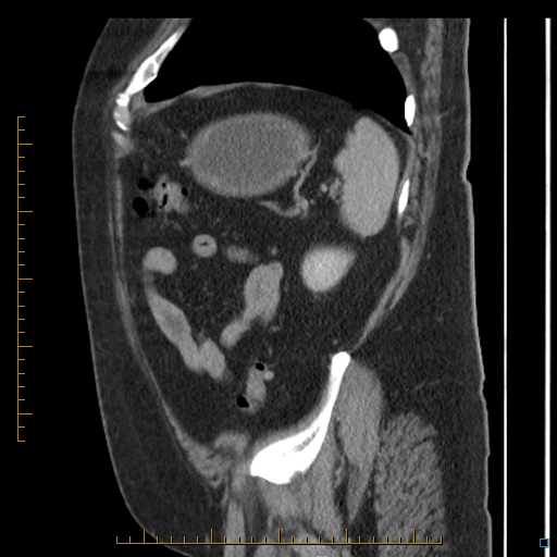 Bariatric balloon causing gastric outlet obstruction (Radiopaedia 54449-60672 C 15).jpg