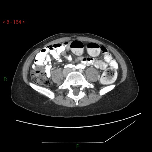 File:Bartholin gland cyst (Radiopaedia 54904-61181 A 41).jpg