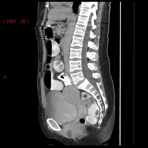 File:Bartholin gland cyst (Radiopaedia 54904-61181 Sagittal C+ delayed 25).jpg