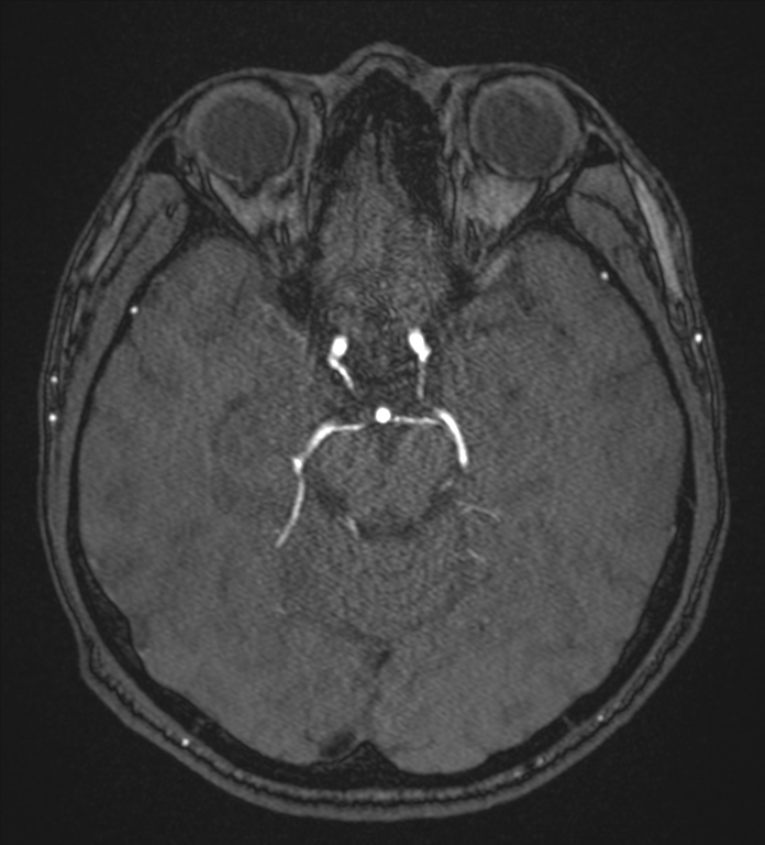 Basal ganglia subacute infarct (Radiopaedia 80201-93521 Axial MRA 48).png