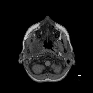 Base of skull rhabdomyosarcoma (Radiopaedia 32196-33142 Axial T1 4).jpg