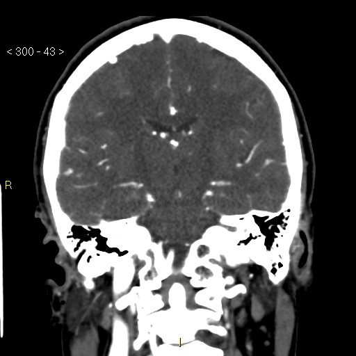 File:Basilar artery thrombosis (Radiopaedia 16260-15944 B 34).jpg