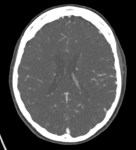 Basilar tip aneurysm with coiling (Radiopaedia 53912-60086 A 92).jpg