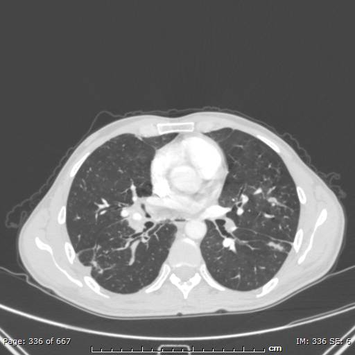 File:Behçet disease (Radiopaedia 44247-47889 Axial lung window 44).jpg