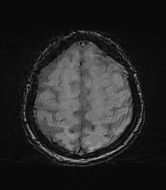 File:Behavioral variant frontotemporal dementia and late onset schizophrenia (Radiopaedia 52197-58083 Axial SWI 60).png