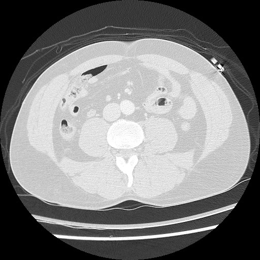 Benign post-traumatic pseudopneumoperitoneum (Radiopaedia 71199-81495 Axial lung window 98).jpg