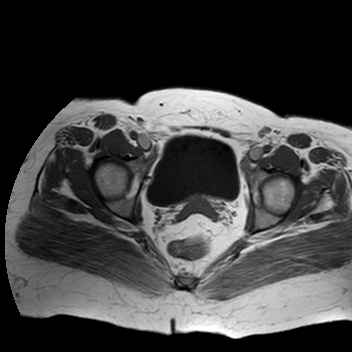 File:Benign seromucinous cystadenoma of the ovary (Radiopaedia 71065-81300 Axial T1 5).jpg