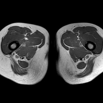File:Bicornuate uterus (Radiopaedia 61974-70046 Axial T1 50).jpg