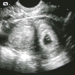 File:Bicornuate uterus with early intrauterine pregnancy (Radiopaedia 23599-23714 C 1).jpeg