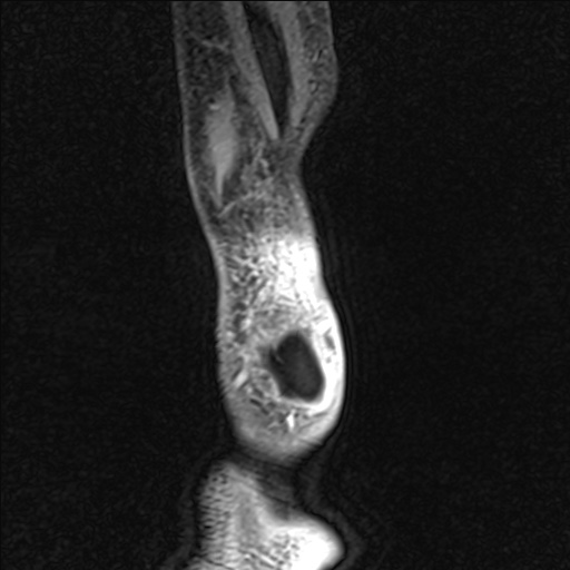 Bilateral Achilles tendon complete tear (Radiopaedia 81344-95051 Sagittal WE - Left 103).jpg