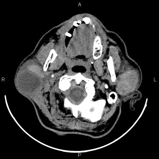 Bilateral Warthin tumors (Radiopaedia 84034-99263 Axial non-contrast 16).jpg