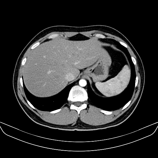 Bilateral accessory renal arteries with mild pelvi-ureteric junction (PUJ) obstruction (Radiopaedia 66357-75596 A 5).jpg