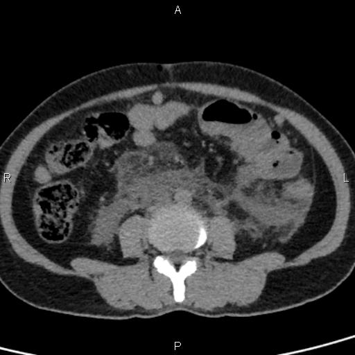 Bilateral adrenal gland hyperenhancement in pancreatitis (Radiopaedia 86642-102753 Axial non-contrast 66).jpg