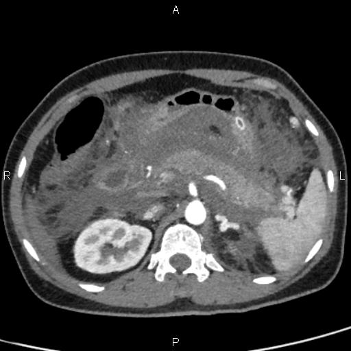 Bilateral adrenal gland hyperenhancement in pancreatitis (Radiopaedia 86642-102753 B 43).jpg