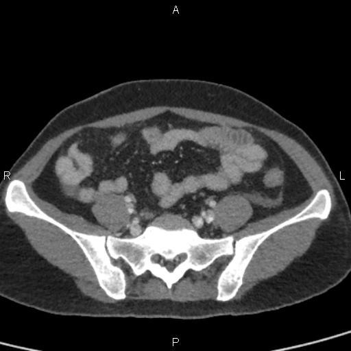 File:Bilateral adrenal gland hyperenhancement in pancreatitis (Radiopaedia 86642-102753 E 84).jpg