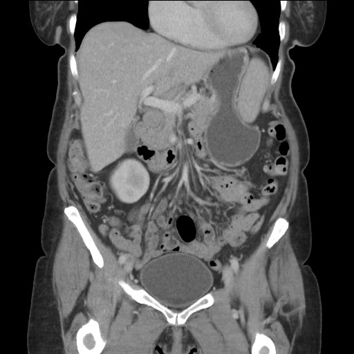Bilateral adrenal granulocytic sarcomas (chloromas) (Radiopaedia 78375-91007 B 38).jpg