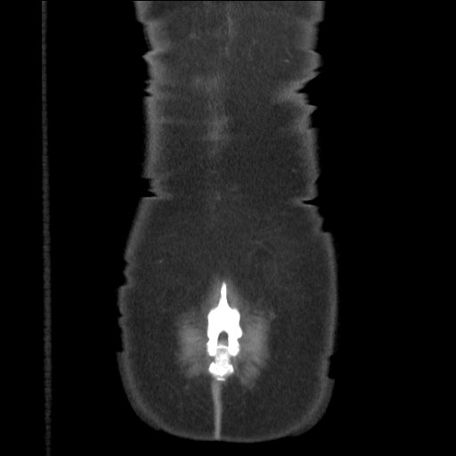 Bilateral adrenal granulocytic sarcomas (chloromas) (Radiopaedia 78375-91007 B 88).jpg