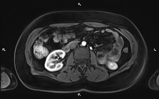 Bilateral adrenal myelolipoma (Radiopaedia 63058-71537 Axial T1 C+ fat sat 55).jpg