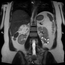 File:Bilateral adrenal myelolipoma (Radiopaedia 63058-71537 Coronal T2 11).jpg