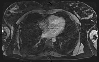 File:Bilateral adrenal myelolipoma (Radiopaedia 63058-71537 H 2).jpg