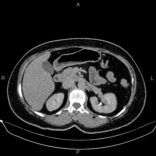 File:Bilateral benign adrenal adenomas (Radiopaedia 86912-103124 Axial C+ delayed 45).jpg