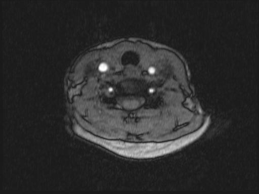 Bilateral carotid body tumors and right glomus jugulare tumor (Radiopaedia 20024-20060 Axial MRA 218).jpg