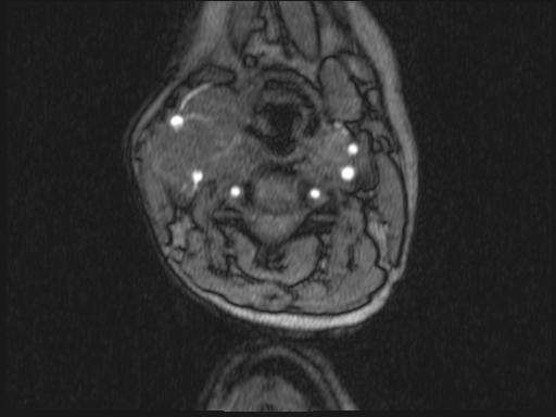 Bilateral carotid body tumors and right glomus jugulare tumor (Radiopaedia 20024-20060 Axial MRA 252).jpg
