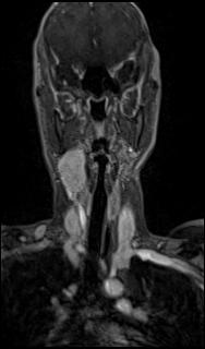 Bilateral carotid body tumors and right glomus jugulare tumor (Radiopaedia 20024-20060 MRA 18).jpg
