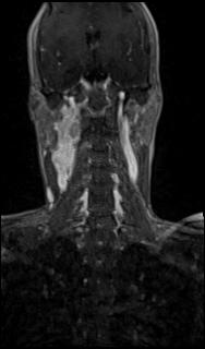 Bilateral carotid body tumors and right glomus jugulare tumor (Radiopaedia 20024-20060 MRA 36).jpg